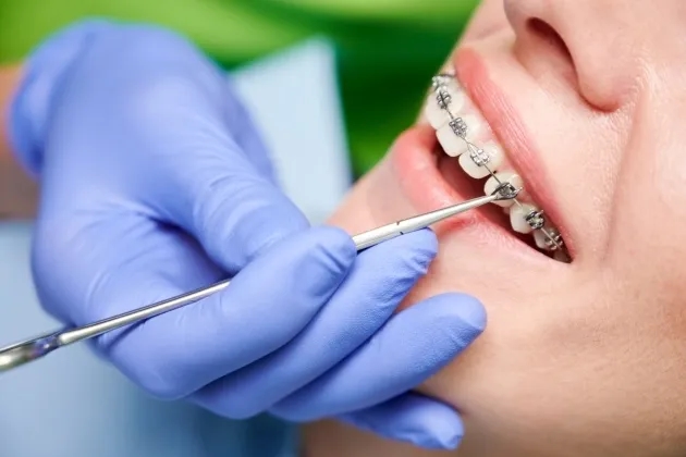 Tanara cu aparat dentar cu bracketi metalici